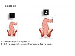0814 rectum medical images for powerpoint