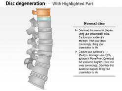 0814 spine conditions medical images for powerpoint