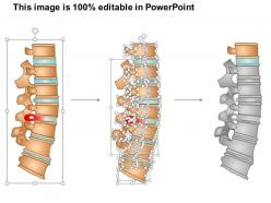 0814 spine conditions medical images for powerpoint