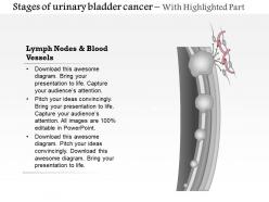 0814 stages of urinary bladder cancer medical images for powerpoint