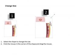 0814 stages of urinary bladder cancer medical images for powerpoint