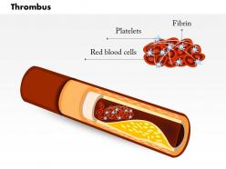 0814 thrombus medical images for powerpoint