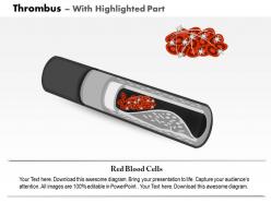 0814 thrombus medical images for powerpoint