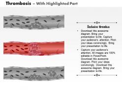 0814 types of thrombosis medical images for powerpoint