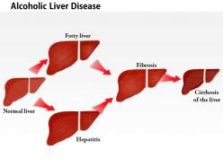 0914 alcoholic liver disease medical images for powerpoint