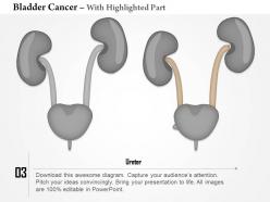 0914 bladder cancer medical images for powerpoint