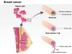 0914 breast cancer medical images for powerpoint
