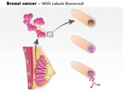0914 breast cancer medical images for powerpoint