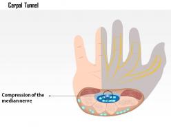 0914 carpal tunnel syndrome diseases medical images for powerpoint