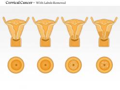 0914 cervical cancer medical images for powerpoint