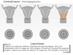 0914 cervical cancer medical images for powerpoint