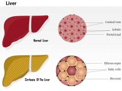 0914 cirrhosis of the liver and normal liver structure medical images for powerpoint