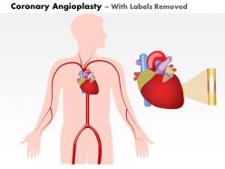 0914 coronary angioplasty medical images for powerpoint