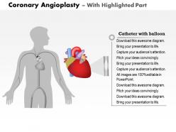 0914 coronary angioplasty medical images for powerpoint