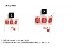 0914 kock pouch colon surgery medical images for powerpoint