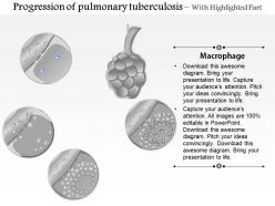 0914 progression of pulmonary tuberculosis medical images for powerpoint