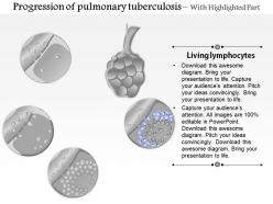 0914 progression of pulmonary tuberculosis medical images for powerpoint