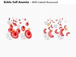 0914 sickle cell anemia medical images for powerpoint