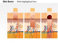 0914 skin burns medical images for powerpoint