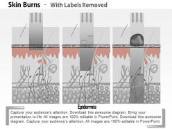 0914 skin burns medical images for powerpoint
