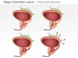 0914 stages of prostate cancer medical images for powerpoint
