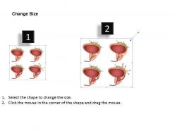 0914 stages of prostate cancer medical images for powerpoint