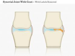 0914 synovial joint with gout medical images for powerpoint