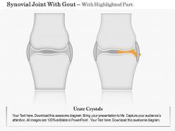 0914 synovial joint with gout medical images for powerpoint