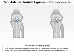 0914 torn anterior cruciate ligament medical images for powerpoint
