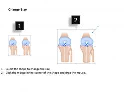 0914 torn anterior cruciate ligament medical images for powerpoint