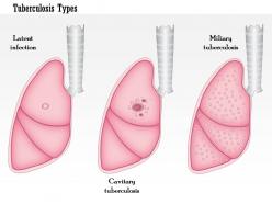 0914 tuberculosis types medical images for powerpoint