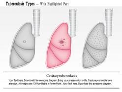 0914 tuberculosis types medical images for powerpoint