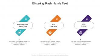 Blistering Rash Hands Feet In Powerpoint And Google Slides Cpb