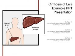 Cirrhosis of live example ppt presentation