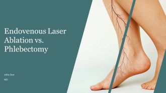 Endovenous Laser Ablation Vs Phlebectomy For Varicose Veins PPT Designs AT
