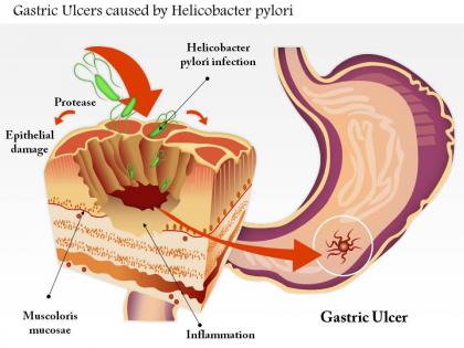 0614 gastric ulcers caused by helicobacter pylori medical images for powerpoint