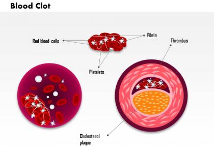 0814 blood clot medical images for powerpoint