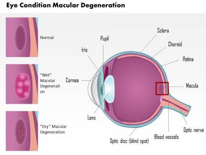 0814 eye condition macular degeneration medical images for powerpoint