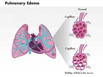 0814 pulmonary edema medical images for powerpoint
