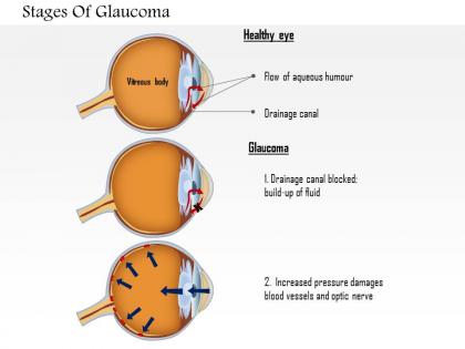 0814 stages of glaucoma medical images for powerpoint