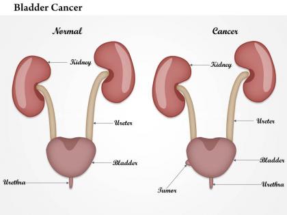 0914 bladder cancer medical images for powerpoint