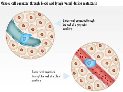 0914 cancer cell squeezes through blood and lymph vessel during metastasis medical images for powerpoint