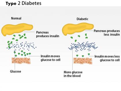 0914 type 2 diabetes medical images for powerpoint