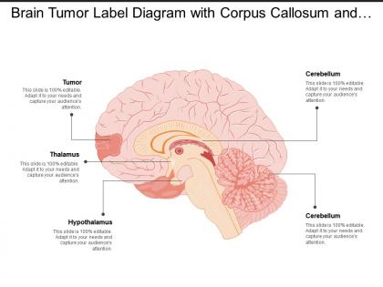 Brain tumor label diagram with corpus callosum and hypothalamus
