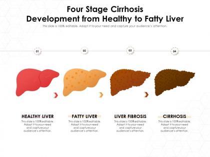 Four stage cirrhosis development from healthy to fatty liver