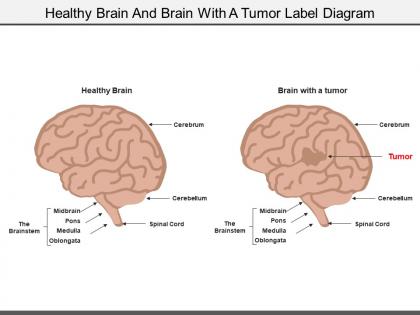 Healthy brain and brain with a tumor label diagram