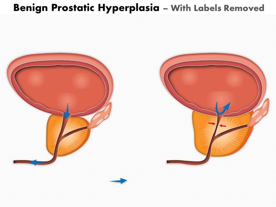 benign prostatic hyperplasia treatment ppt