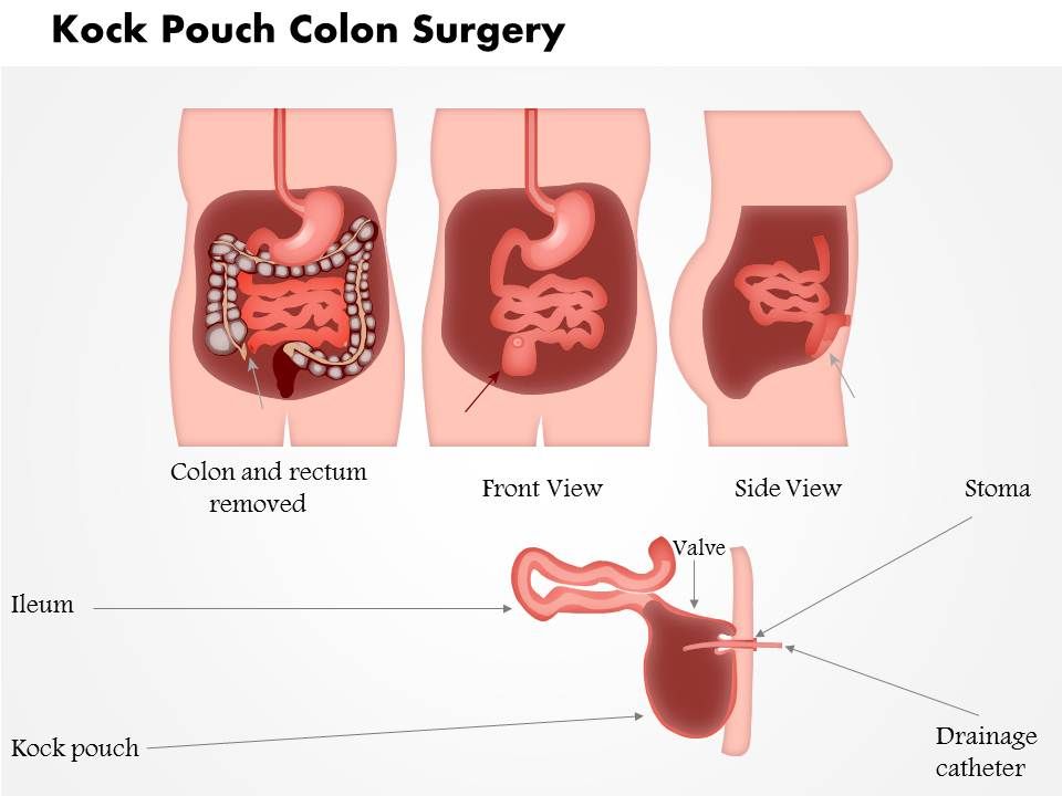 0914 Kock Pouch Colon Surgery Medical Images For PowerPoint
