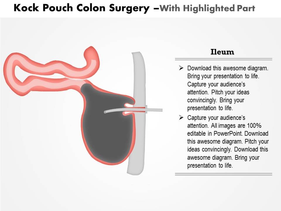 0914 Kock Pouch Colon Surgery Medical Images For PowerPoint