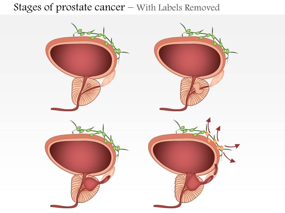 prostate cancer case presentation ppt